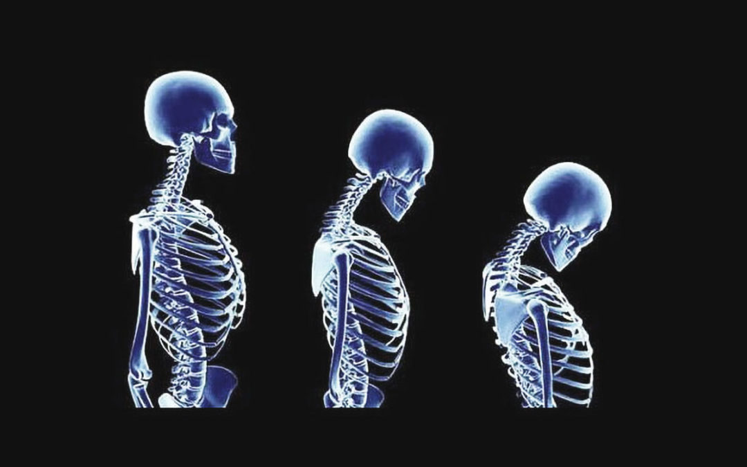 Osteoporosis: Exercise and Diet Tips for all Ages