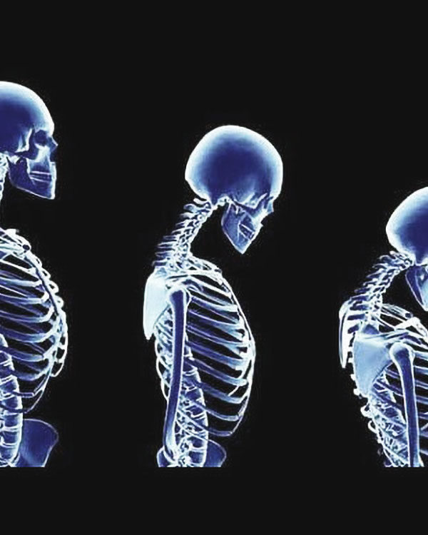 Osteoporosis: Exercise and Diet Tips for all Ages