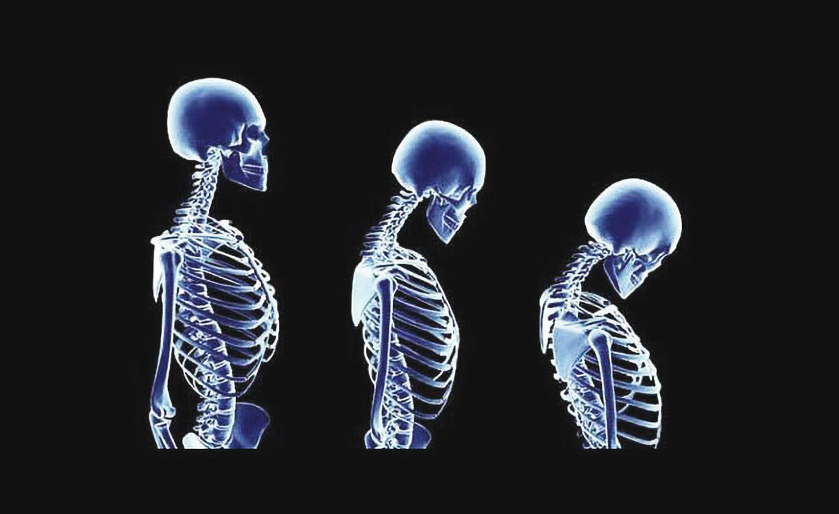 Osteoporosis- Exercise-and-Diet-Tips-for-all-Ages Osteoporosis: Exercise and Diet Tips for all Ages