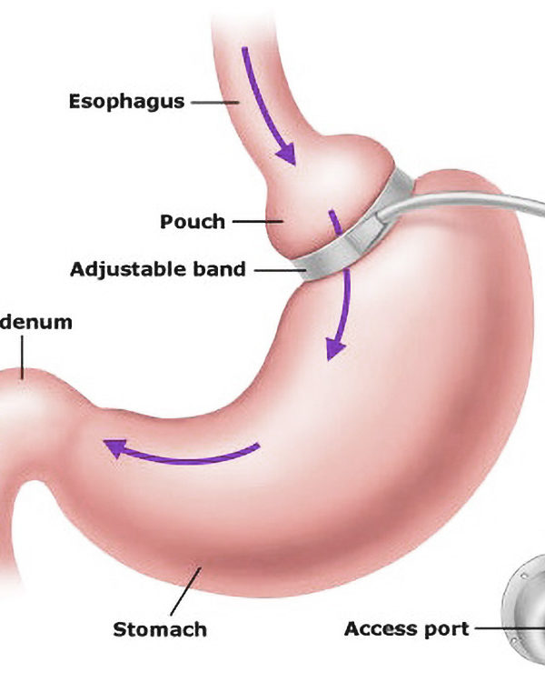 Overweight: Is Gastric Banding Surgery for You?