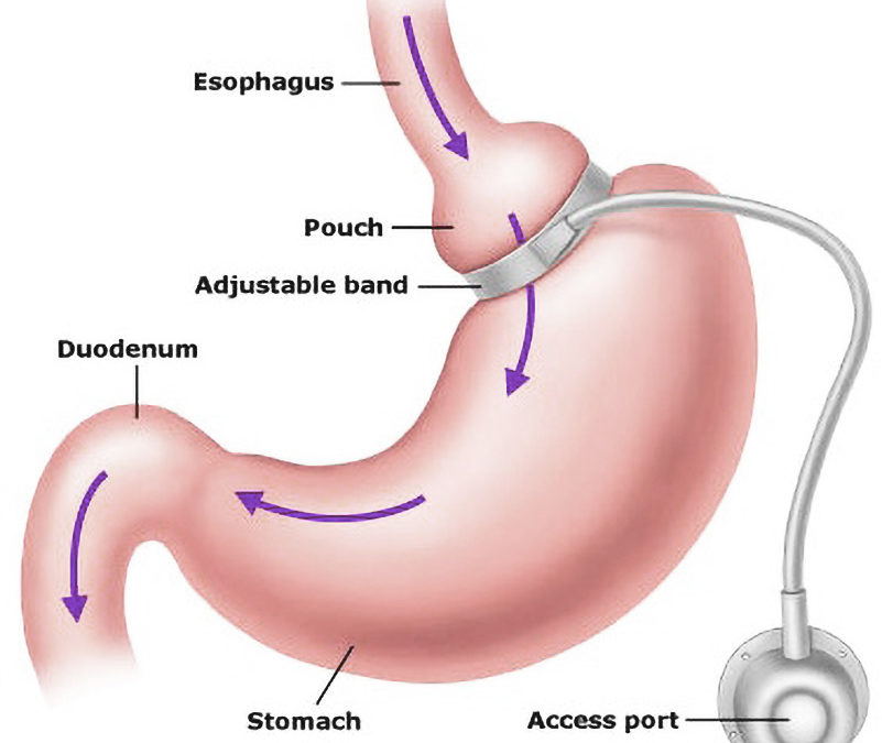 Overweight: Is Gastric Banding Surgery for You?