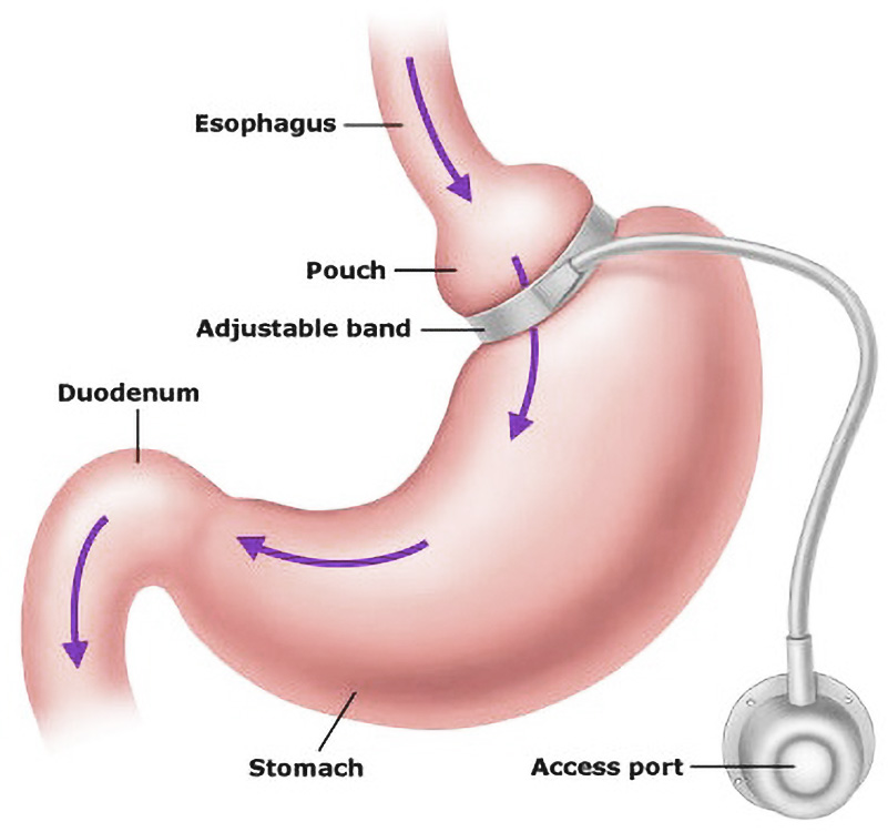 Overweight-Is-Gastric-Banding-Surgery-for-You Overweight: Is Gastric Banding Surgery for You?