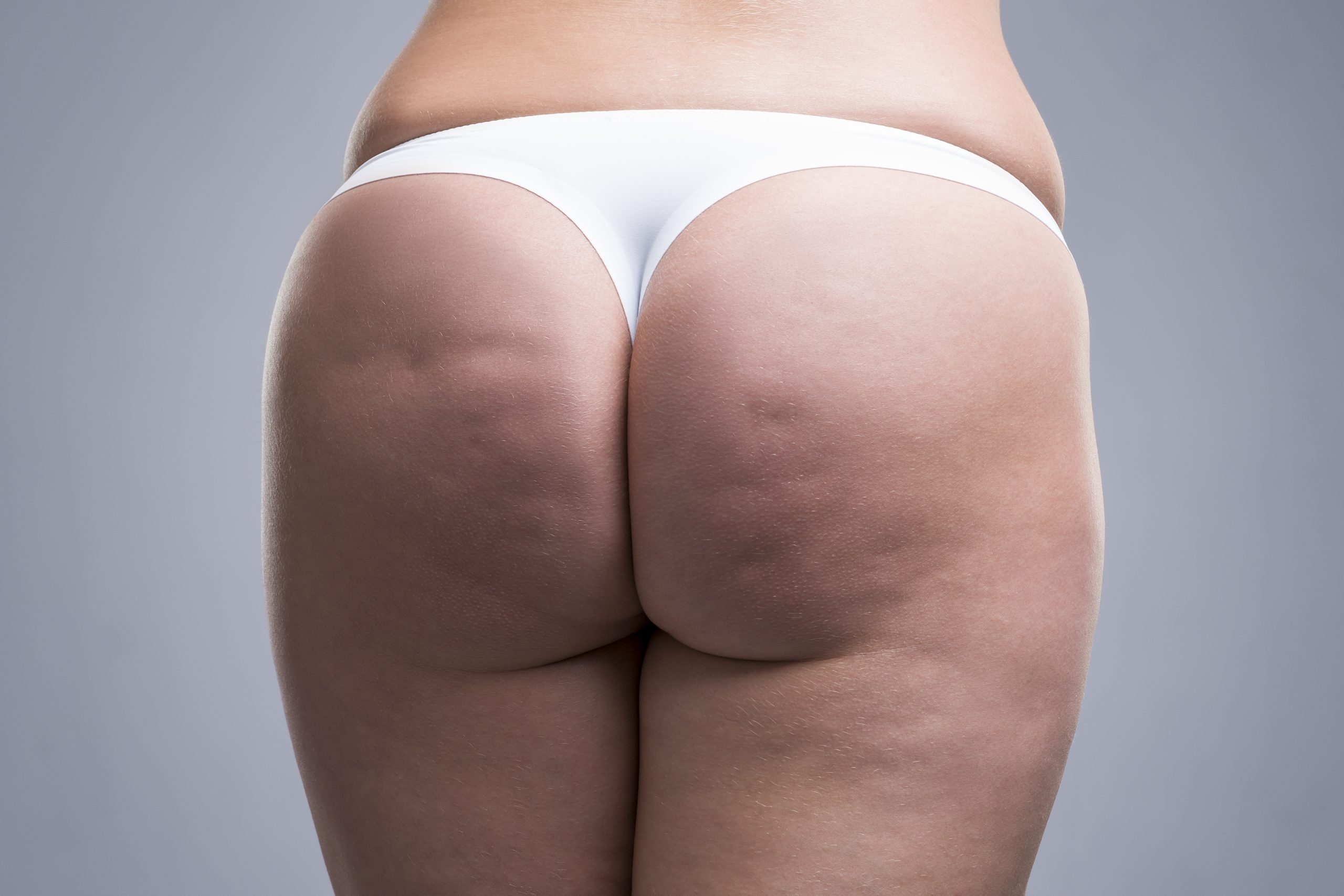 Fat,Female,Body,With,Cellulite,,Fatty,Hips,And,Buttocks,,Gray